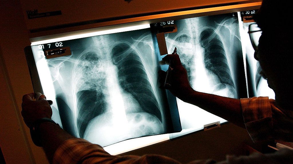 2 active tuberculosis cases traced to San Francisco strip club — KTVU FOX 2 Bay Area, Mountain View Health news